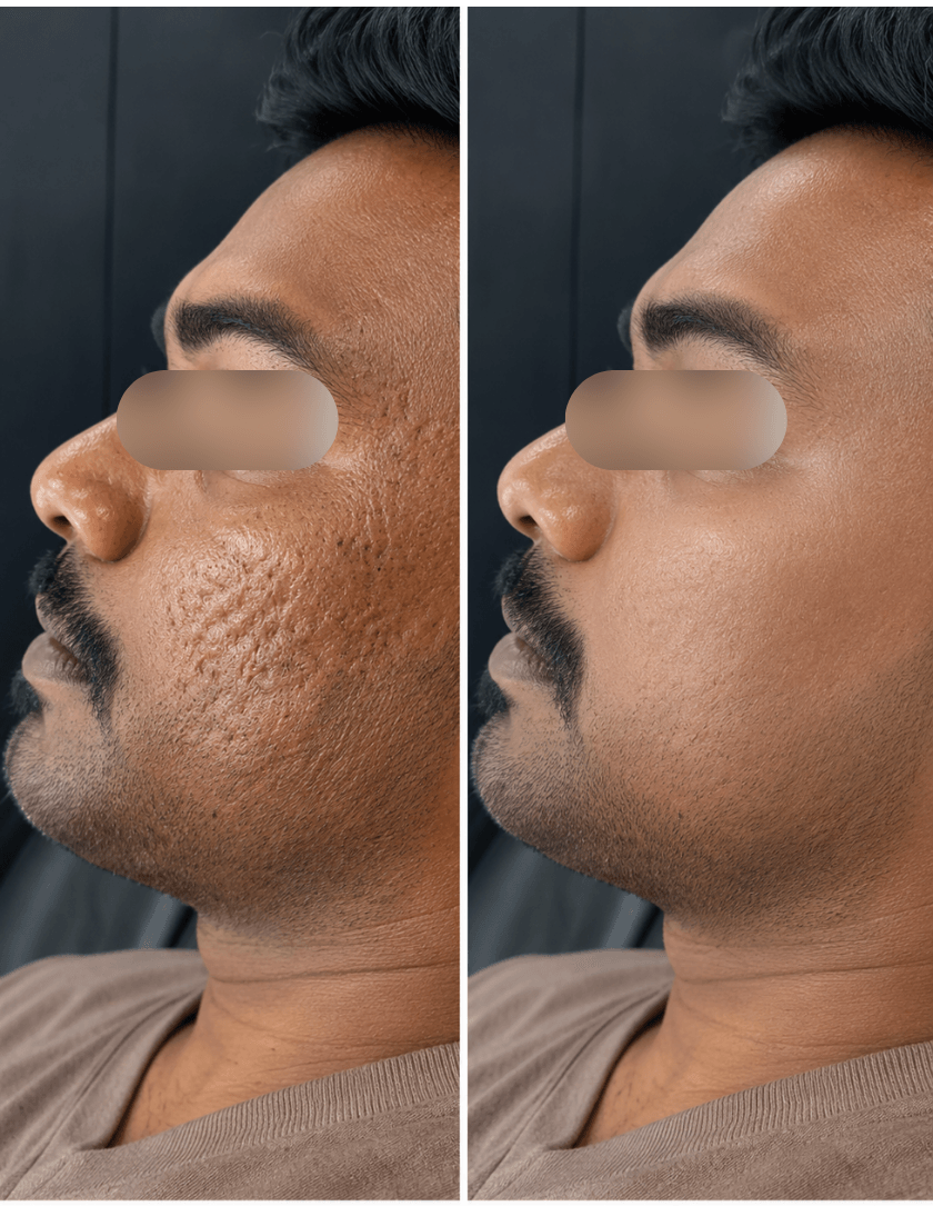 Before and after acne scar smoothing side profile result